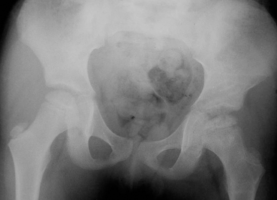 Perthes disease after hip distractioon treatment