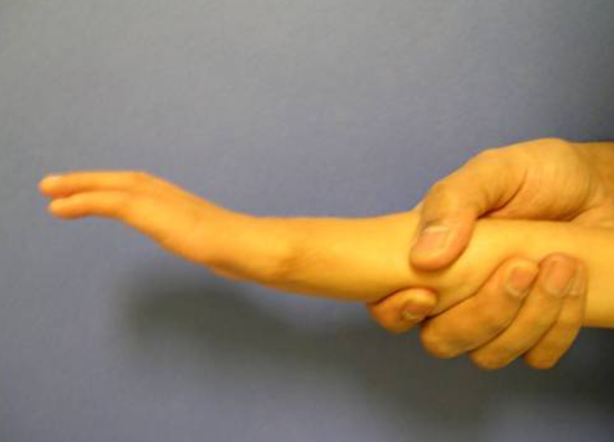 Radial club hand after surgery 2