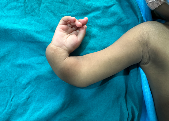 Radial Club Hand Rare Congenital Deformity