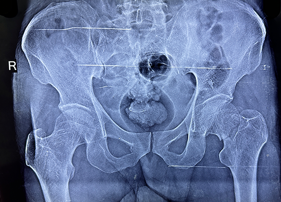 Fracture of hip treated with plate and screws instead of Joint replacement